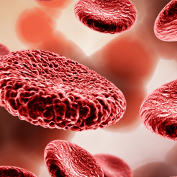 Атеросклероз