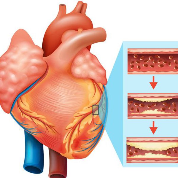 Инфаркт миокарда